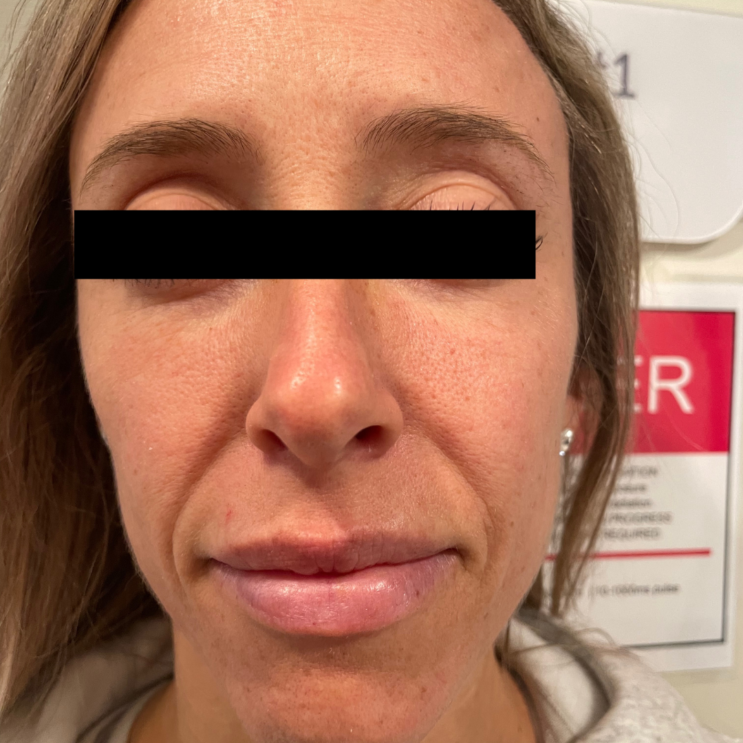 Before & After - Morpheus8 Face & Neck | Sense Esthetics Medical Spa in Port Chester, NY