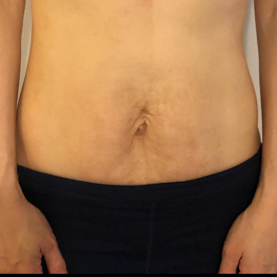 Before & After - Morpheus8 Stomach | Sense Esthetics Medical Spa in Port Chester, NY